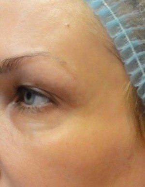 Проведена процедура ботулинотерапии - Ботокс (Botox)