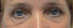 Проведена процедура ботулинотерапии - Ботокс (Botox) - глаза