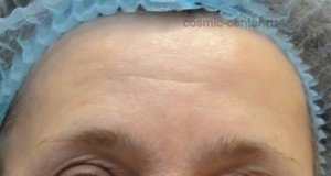 Пациентка 46 лет - лоб