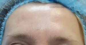 Проведена процедура ботулинотерапии - Ботокс (Botox)-лоб