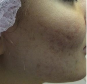 Пациентка 20 лет - лазерная шлифовка постакне